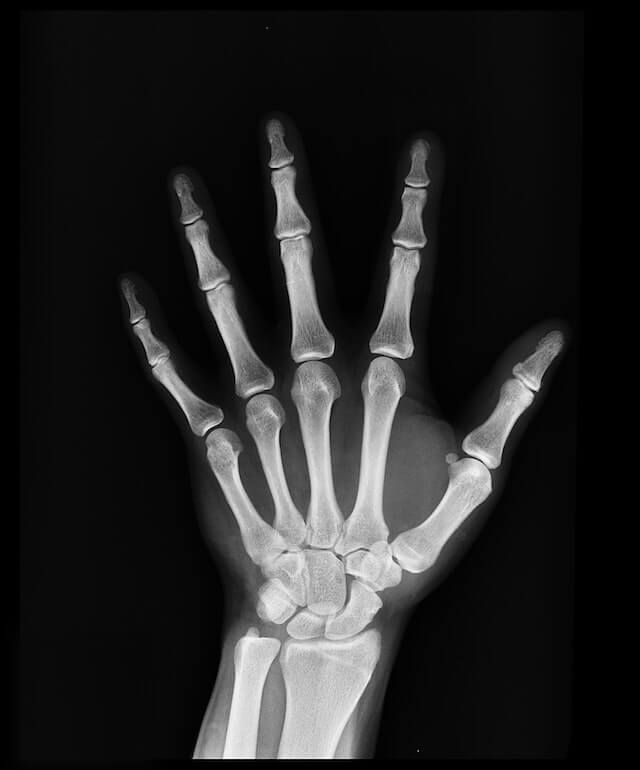 Bone health in focus during awareness week